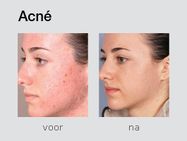 Acne en acnelittekens