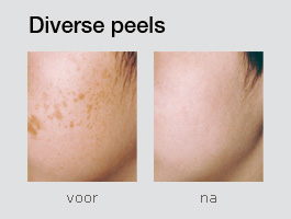 Diverse peels